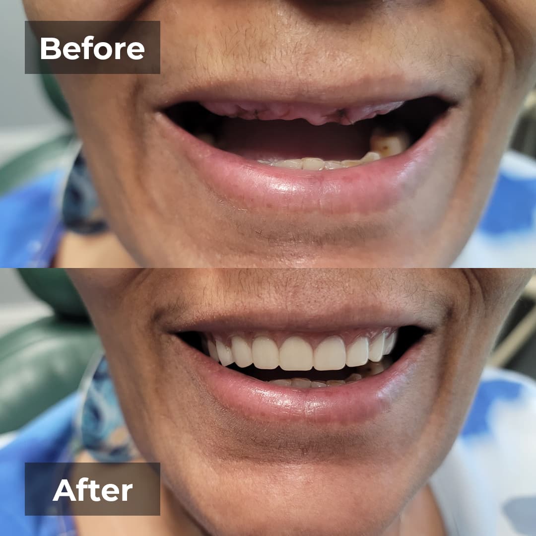 Before and after smile makeover case three