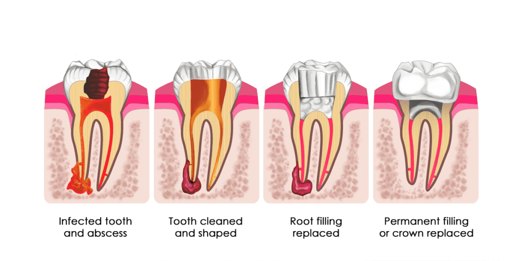 PIPS laser root canal therapy at Coral Springs Smiles