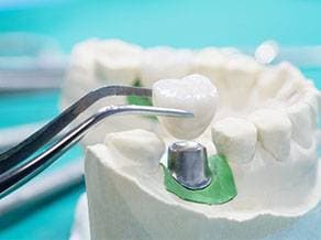 Dental crowns and bridges treatment