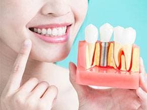 Dental implant and crown model
