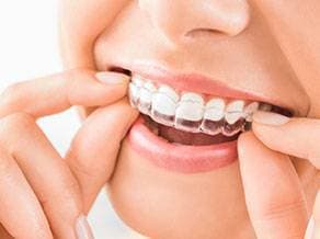 Invisalign clear aligners in Coral Springs