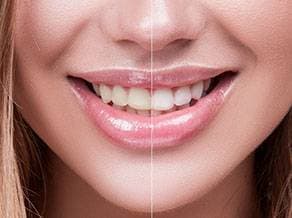 Professional teeth whitening