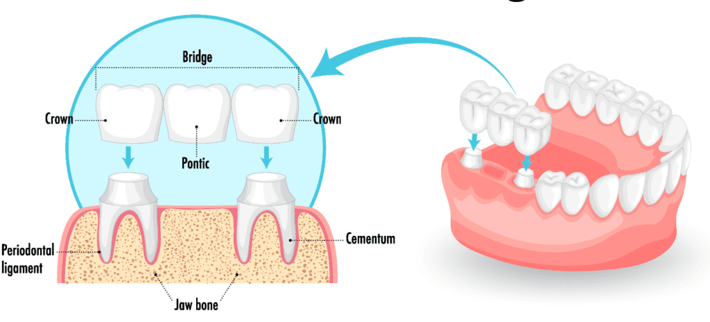 Diagram of a dental bridge showing crowns, pontic, and how the bridge fits on prepared teeth