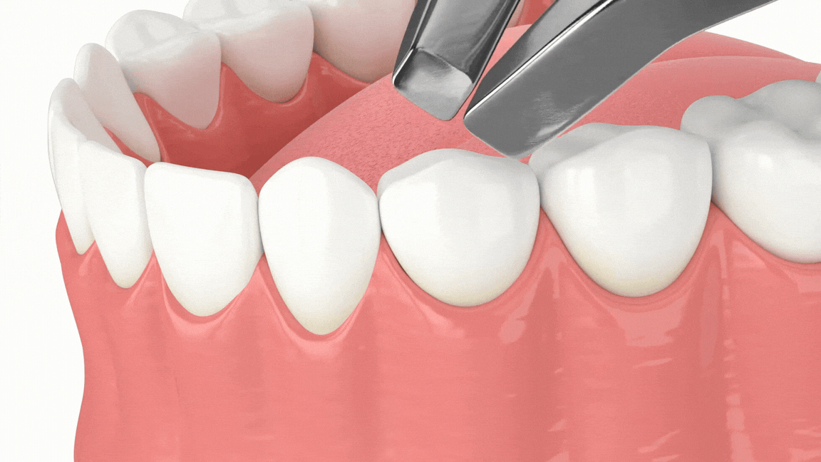 Tooth extraction animation