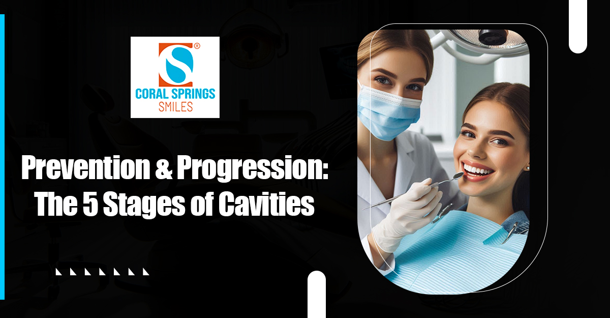 Prevention & Progression: Understanding the 5 Stages of Cavities