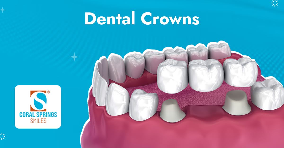 Dental Crowns in Coral Springs, FL | Coral Springs Smiles